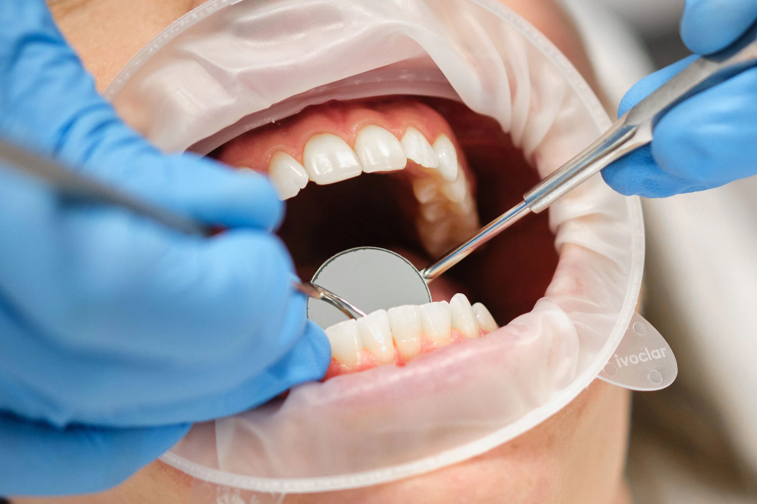 Bakx kosten mondhygienist